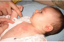 Bebeklerde Pişik Nasıl Geçer?