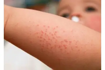 Pişik İçin Ne Yapmalı?