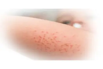 Pişik İlacı Kullanımı ve Faydaları Nelerdir?